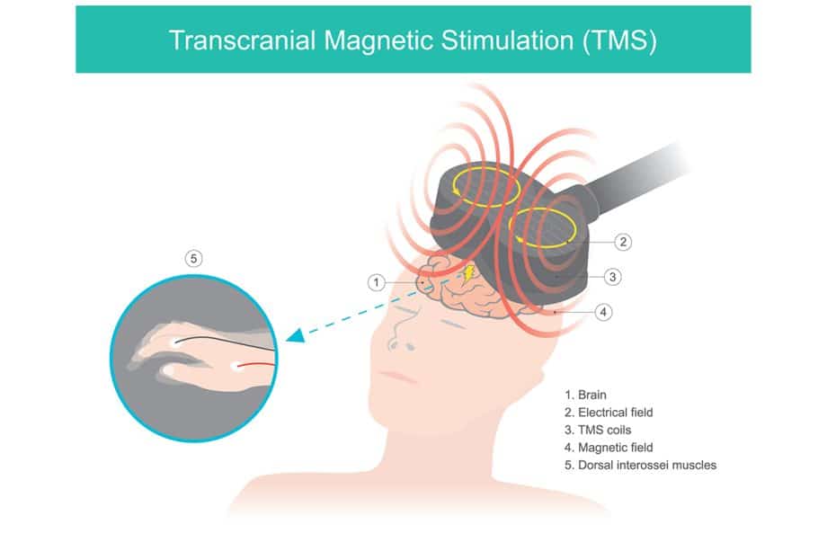 Transcranial Magnetic Stimulation Cost